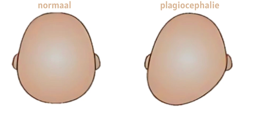 Lijntekening van twee babyhoofdjes: links een symmetrische houding, rechts een voorkeurshouding met het hoofdje naar één kant gedraaid